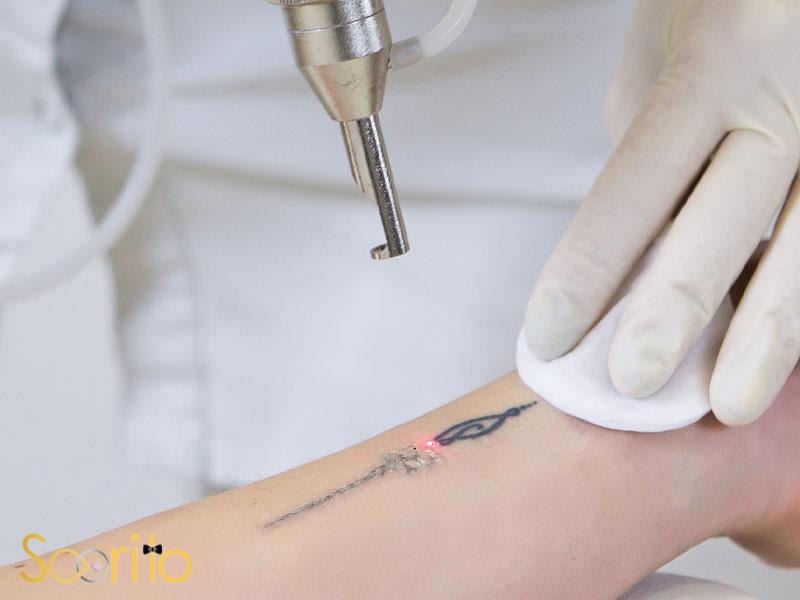 بهترین کلینیک لیزر رفع تاتو در غرب تهران