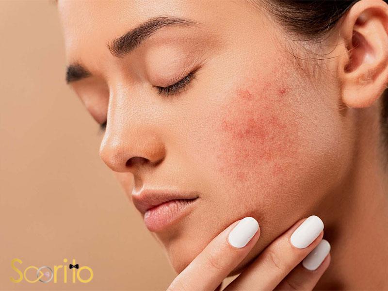 بهترین مرکز درمان لک و جوش صورت در غرب تهران