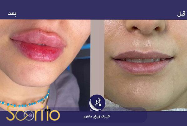 بهترین کلینیک تزریق ژل و فیلر در شمال تهران