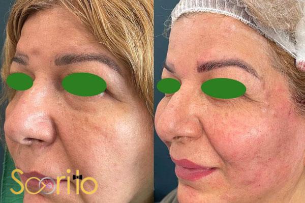 بهترین کلینیک درمان چروک و افتادگی پوست در شمال تهران