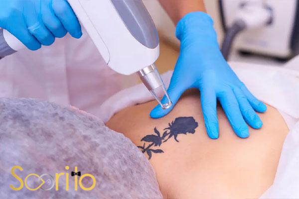 بهترین کلینیک لیزر رفع تاتو در شمال تهران