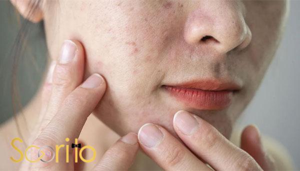 بهترین مرکز درمان لک و جوش صورت در شمال تهران