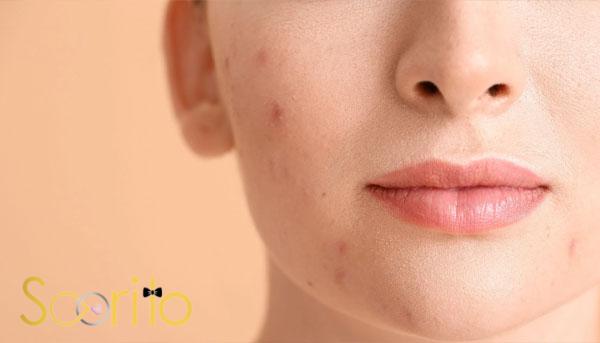 بهترین مرکز درمان لک و جوش صورت در شمال تهران