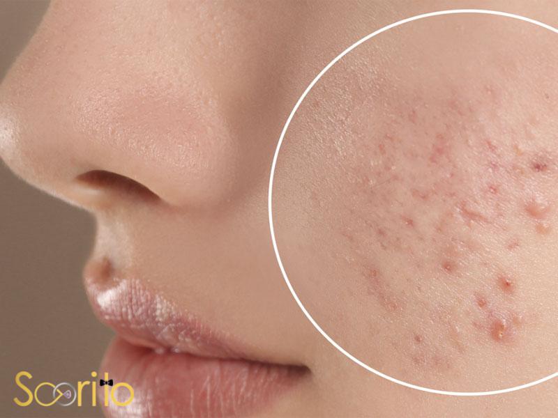 بهترین مرکز درمان لک و جوش صورت در شمال تهران