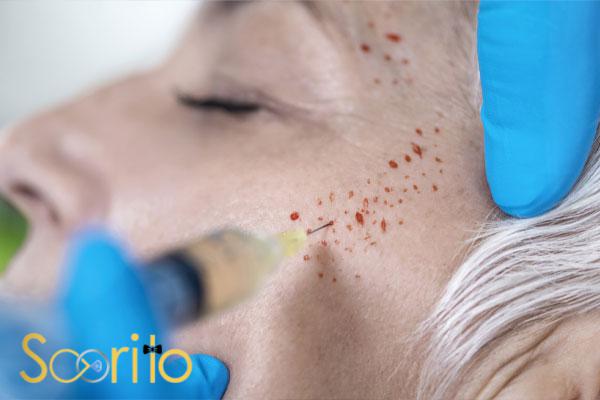 بهترین کلینیک پی آر پی (PRP) و پلاسماتراپی در شمال تهران