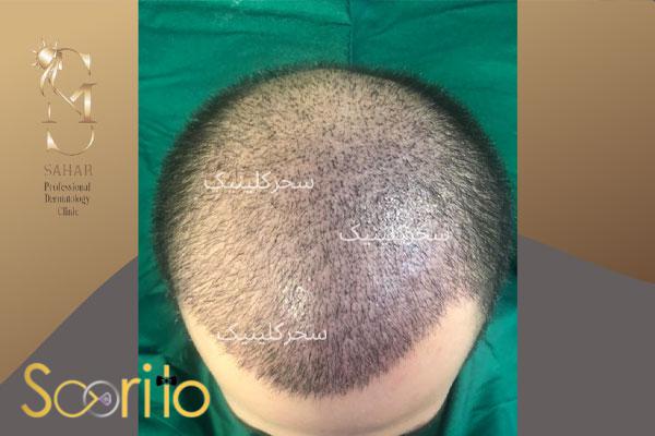 بهترین کلینیک پی آر پی (PRP) و پلاسماتراپی در شمال تهران