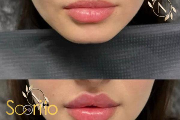 بهترین کلینیک تزریق ژل و فیلر در تهران