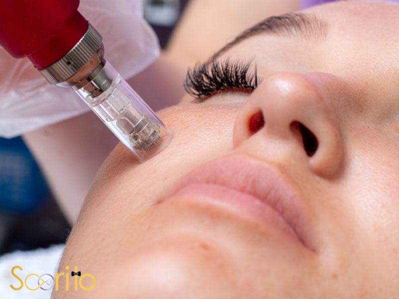 بهترین مرکز میکرونیدلینگ و مزوتراپی در تهران