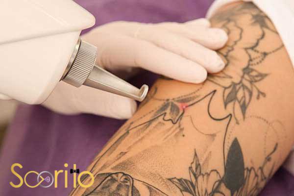 بهترین کلینیک لیزر رفع تاتو در تهران