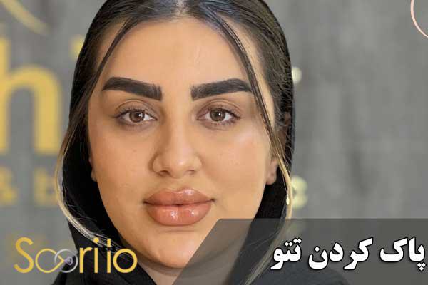 بهترین کلینیک لیزر رفع تاتو در تهران